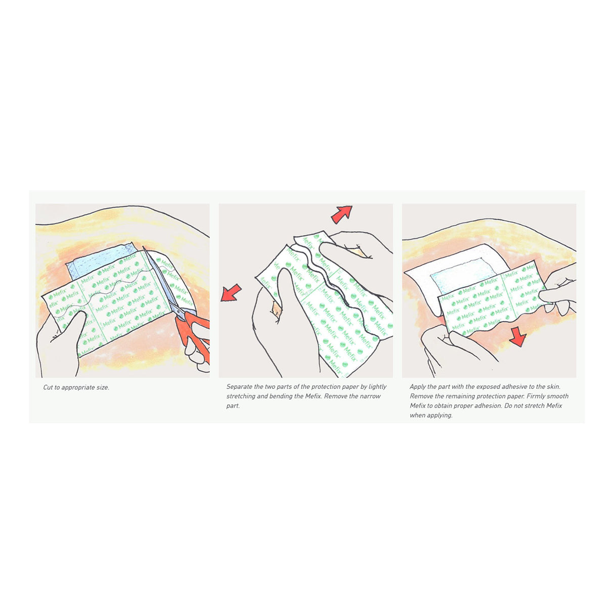 Perforated Dressing Retention Tape with Liner Mefix White 4 Inch X 11 Yard Nonwoven Spunlace Polyester NonSterile
