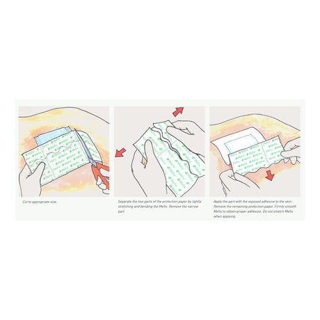 Perforated Dressing Retention Tape with Liner Mefix White 4 Inch X 11 Yard Nonwoven Spunlace Polyester NonSterile